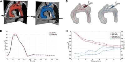 Case Report: Role of numerical simulations in the management of acute aortic syndromes